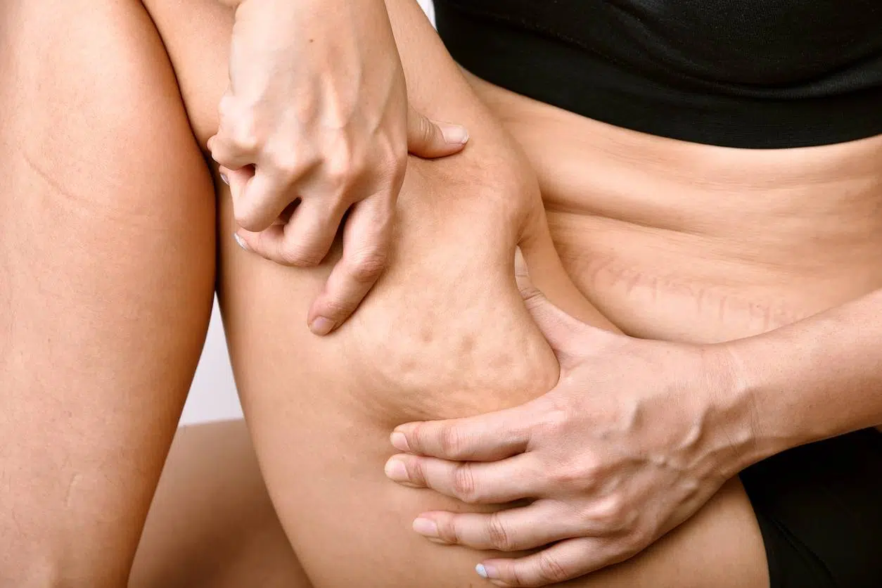 la cellulite comment s'en débarrasse ?