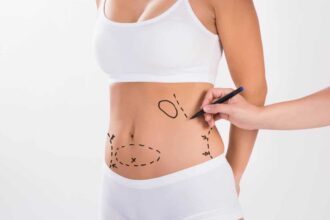Lipoaspiration réalisée par un professionnel de la chirurgie esthétique
